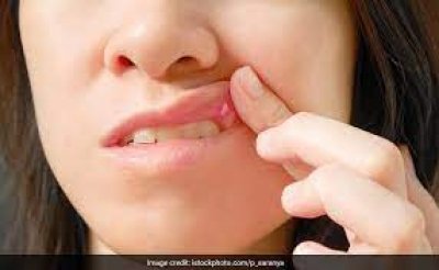 मुंह के छालों से परेशान हैं तो इन 6 चीजों को खा कर पा सकते हैं आराम, जल्द ही देखिए आजमाकर